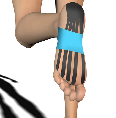 Kinesiotaping, czyli oklejenie stopy elastycznymi lub sztywnymi plastrami